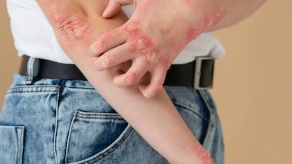 Understanding Rash: Causes, Types, and When to Seek Medical Help