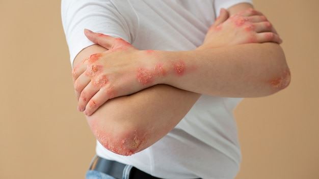 Understanding Scabies Rash Images: A Comprehensive Guide for Diagnosis and Awareness