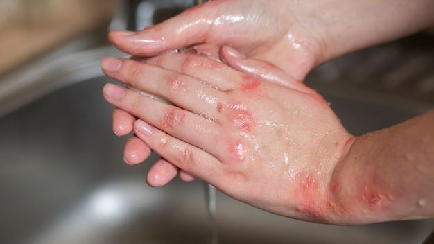 Recognizing Skin Infection Looks Like: A Comprehensive Guide to Understand the Signs