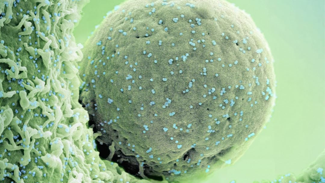 Innovative Approaches to Non Small Cell Lung Carcinoma Treatment: A Comprehensive Guide for Patients and Caregivers