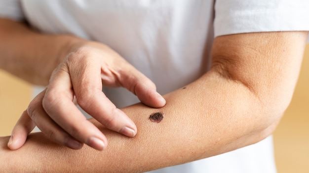 Understanding Melanoma: Comprehensive Guide to Prevention, Detection, and Treatment