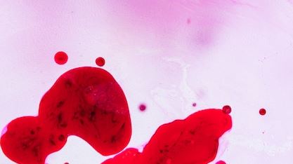 Understanding Multiple Myeloma: Comprehensive Insights into a Complex Blood Cancer