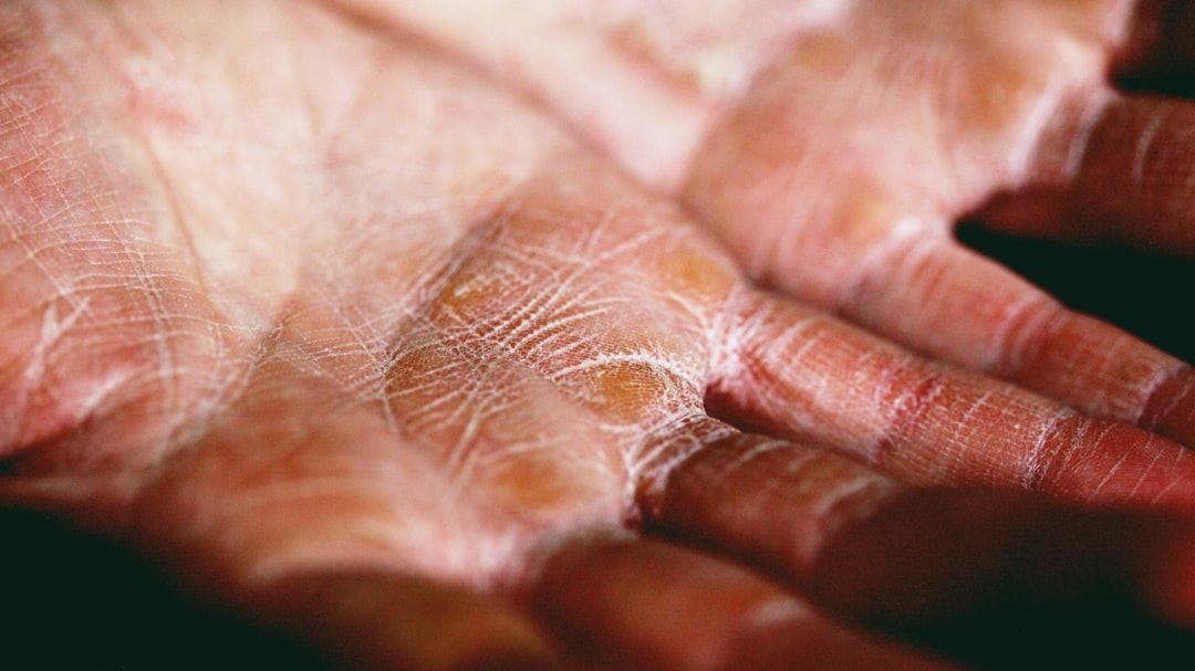 Understanding Pyrosis Skin Condition: Causes, Symptoms, and Treatment Options