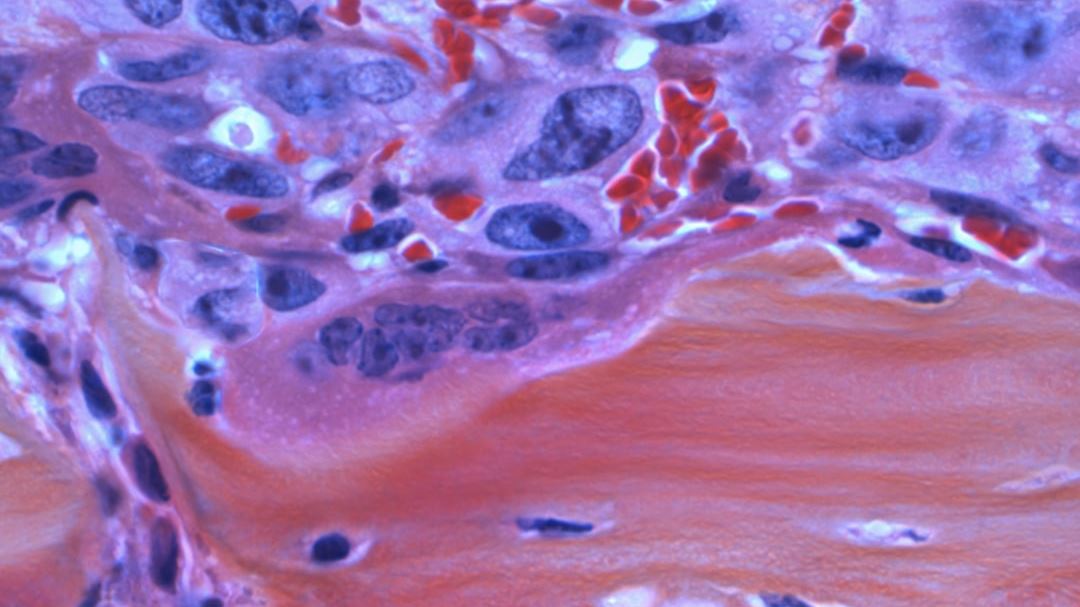 Understanding Enzalutamide and Its Role in Prostate Cancer Management