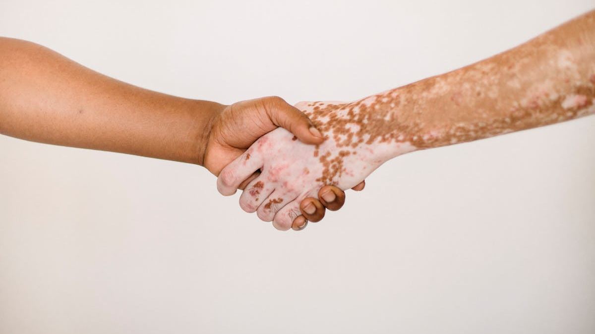 Understanding Psoriasis: A Comprehensive Guide to See Psoriasis Pictures and Recognizing Symptoms in the United States