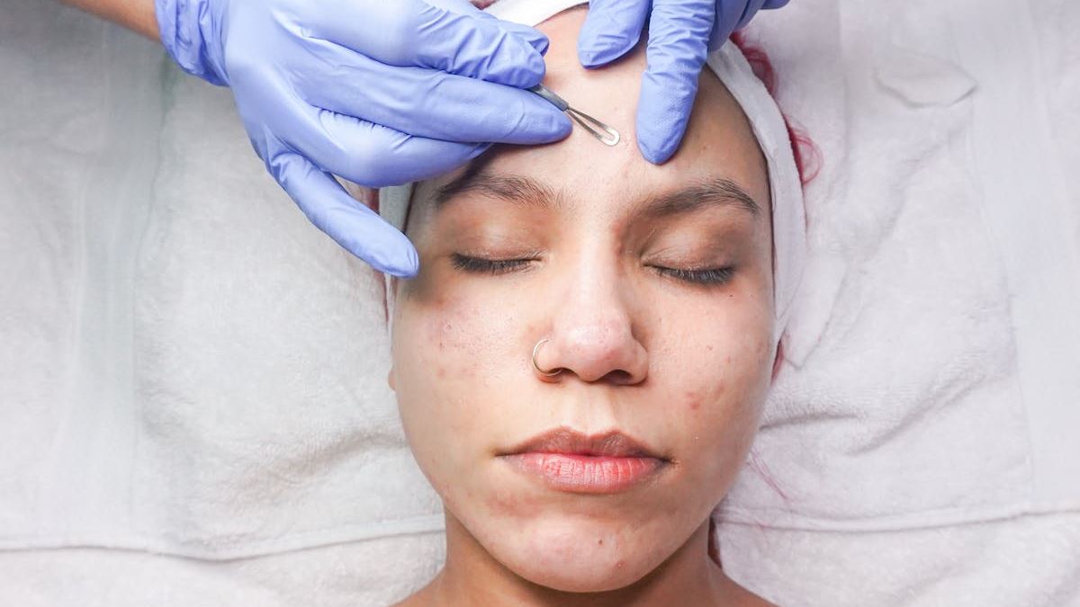The Ultimate Guide to Massive Cystic Pimple Removal: Techniques, Expectations, and Recovery