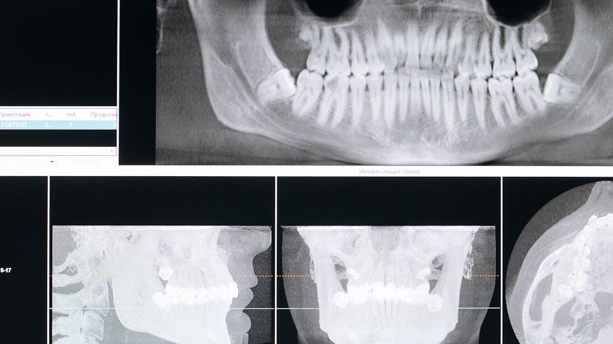 The Ultimate Guide to Dental Implants: Restoring Confidence and Function