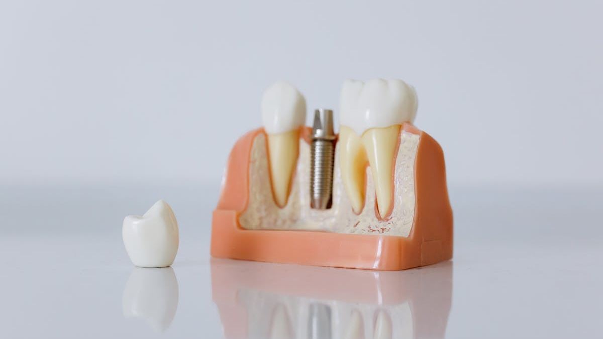 Your Comprehensive Guide to Finding Dental Implants Near Me in the United States