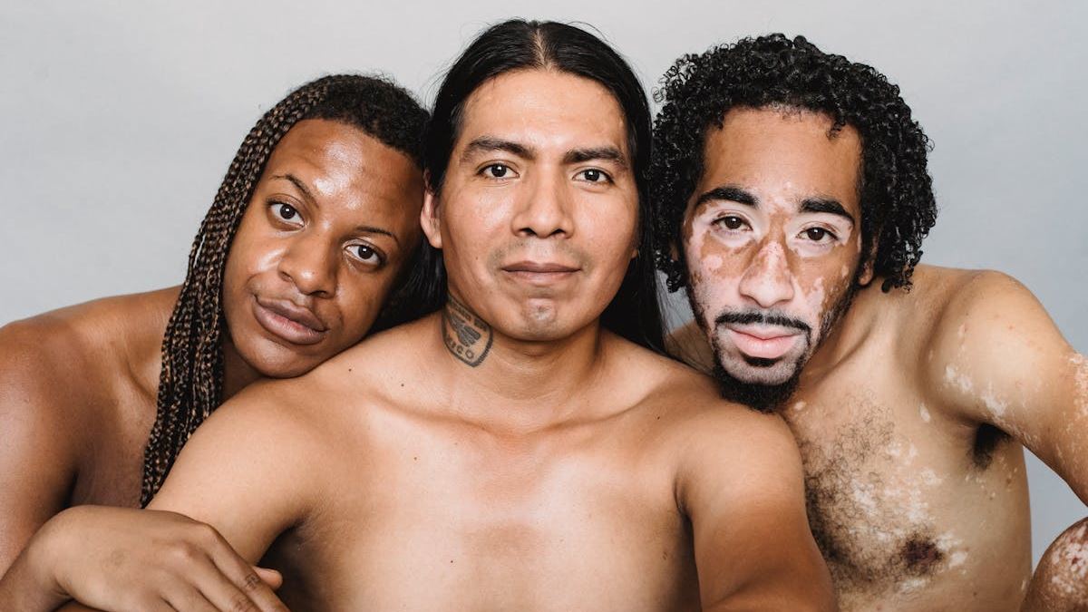 Understanding Vitiligo: Does Vitiligo Look Like What You Expect?