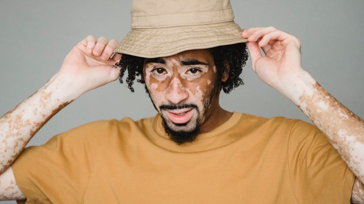 Understanding Vitiligo: What Does Vitiligo Skin Look Like?