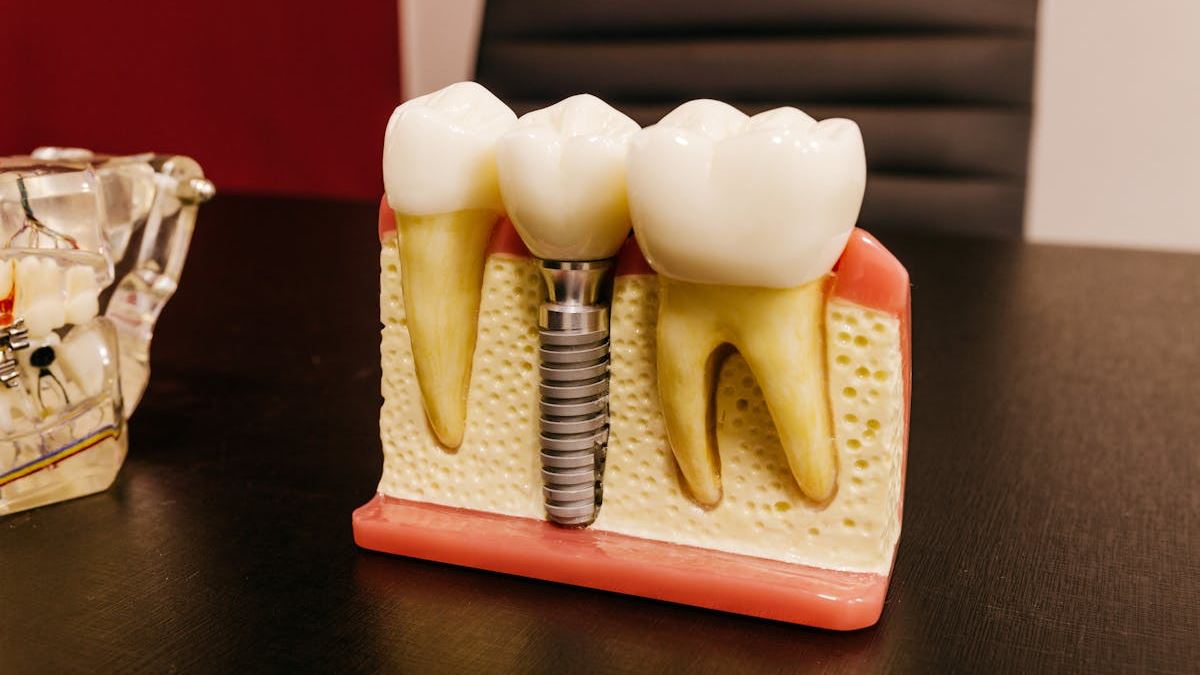 Comprehensive Guide to Low Cost All NN4 Dental Implants in the United States