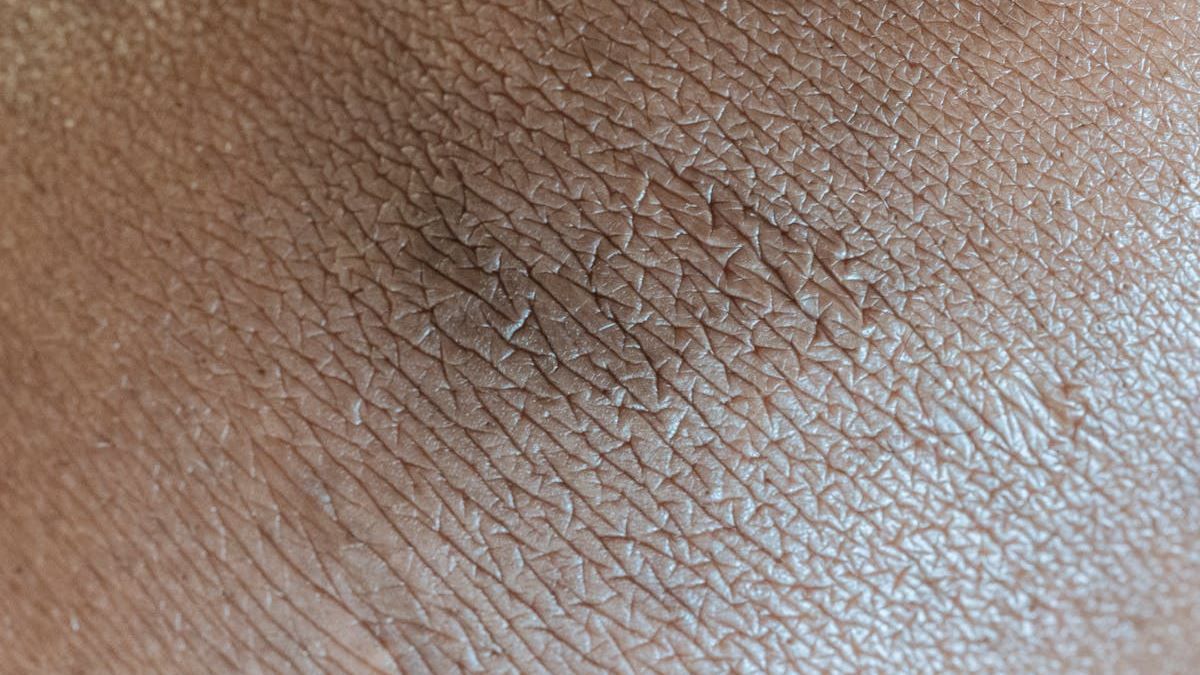 Understanding Lymphoma Skin Rash: Causes, Symptoms, and When to Seek Medical Help