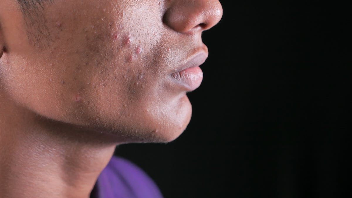 Comprehensive Guide to Big Cystic Pimple Removal: Techniques, Treatments, and Expert Insights