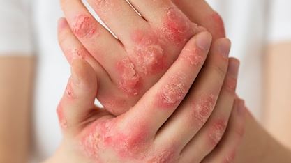 Understanding Atopic Dermatitis: Causes, Symptoms, and Effective Management