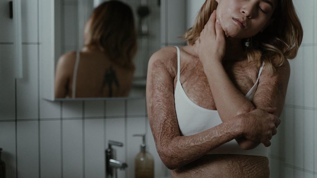 Understanding Picture Prurigo Nodularis Rash: Symptoms, Causes, and Treatment Options