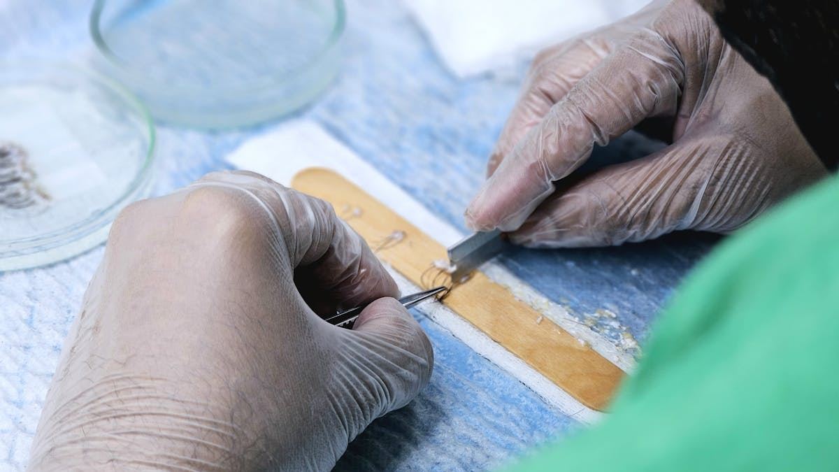 Understanding Psoriasis Scalp: Causes, Symptoms, and Effective Treatments